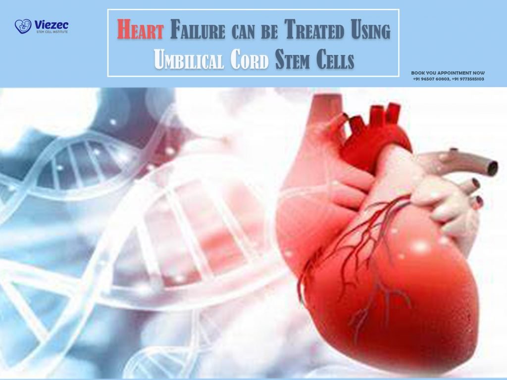 Heart Failure can be Treated Using Umbilical Cord Stem Cells
