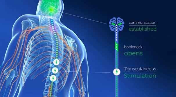 epidural stimulation