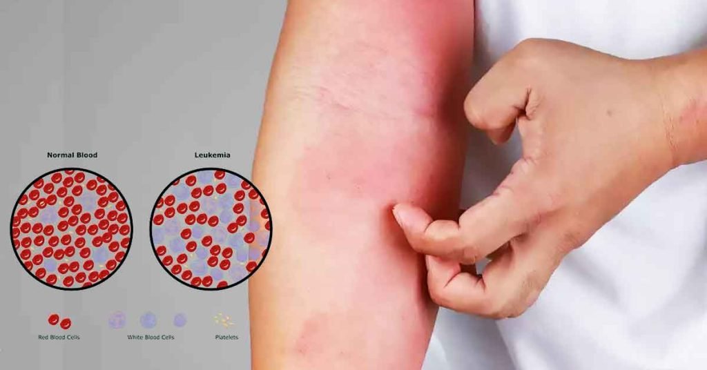 Leukemia Treatment in India Bone Marrow Transplantation