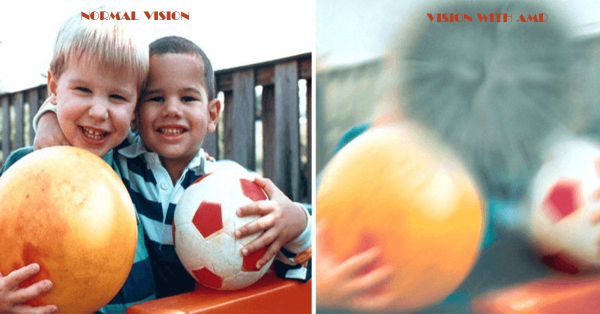 Diet Tips for Macular Degeneration