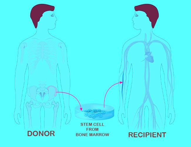 Who are the best candidates for bone marrow transplant