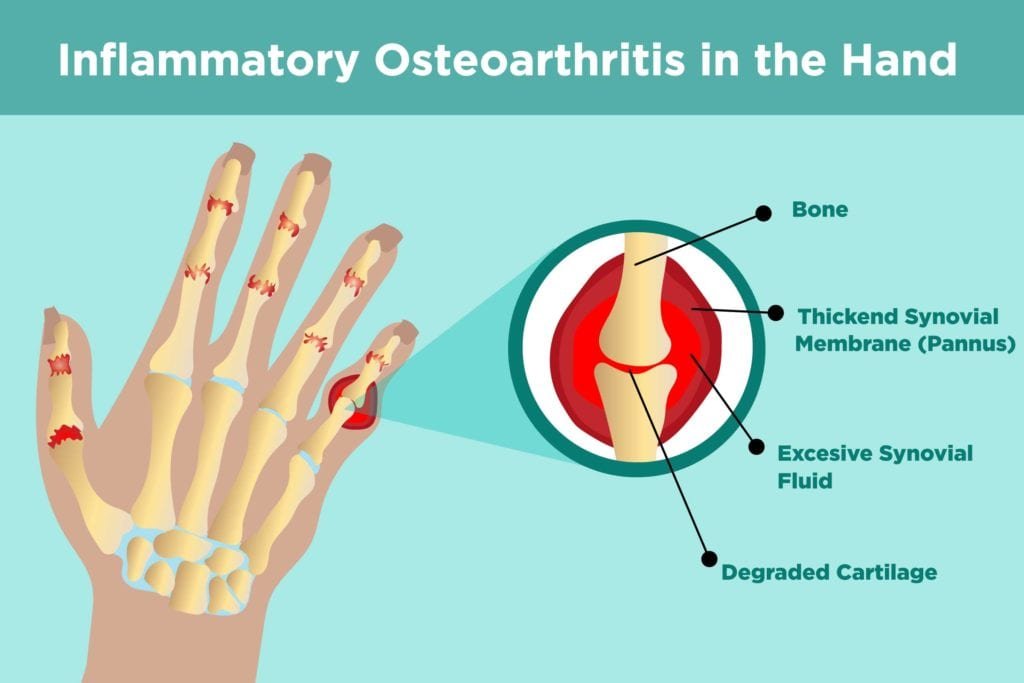 osteoarthritist