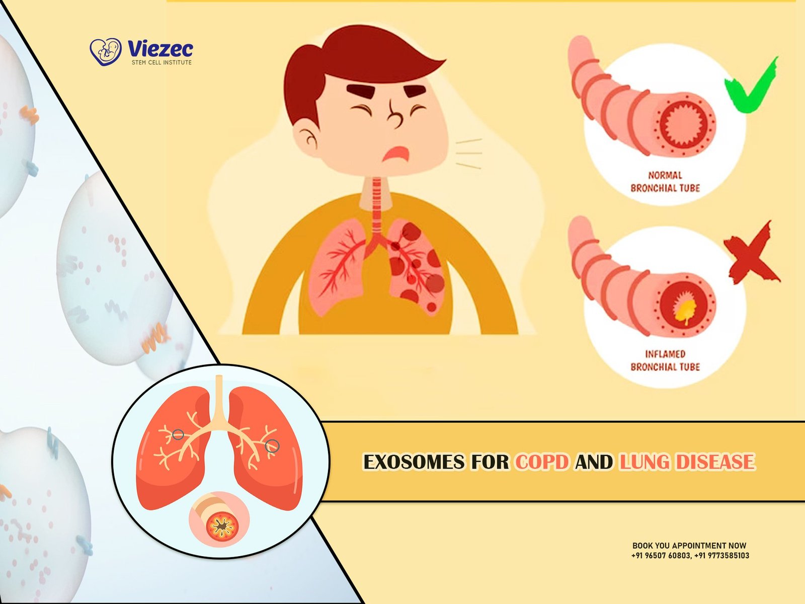 Exosomes For COPD and Lung Disease