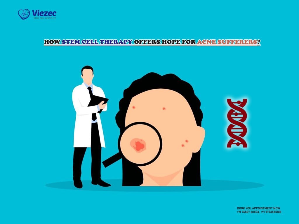 How Stem Cell Therapy Offers Hope for Acne Sufferers