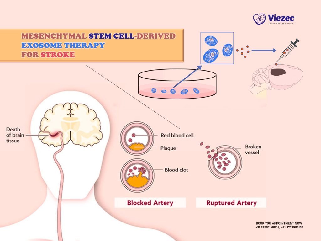 Mesenchymal Stem Cell-Derived Exosome Therapy For Stroke