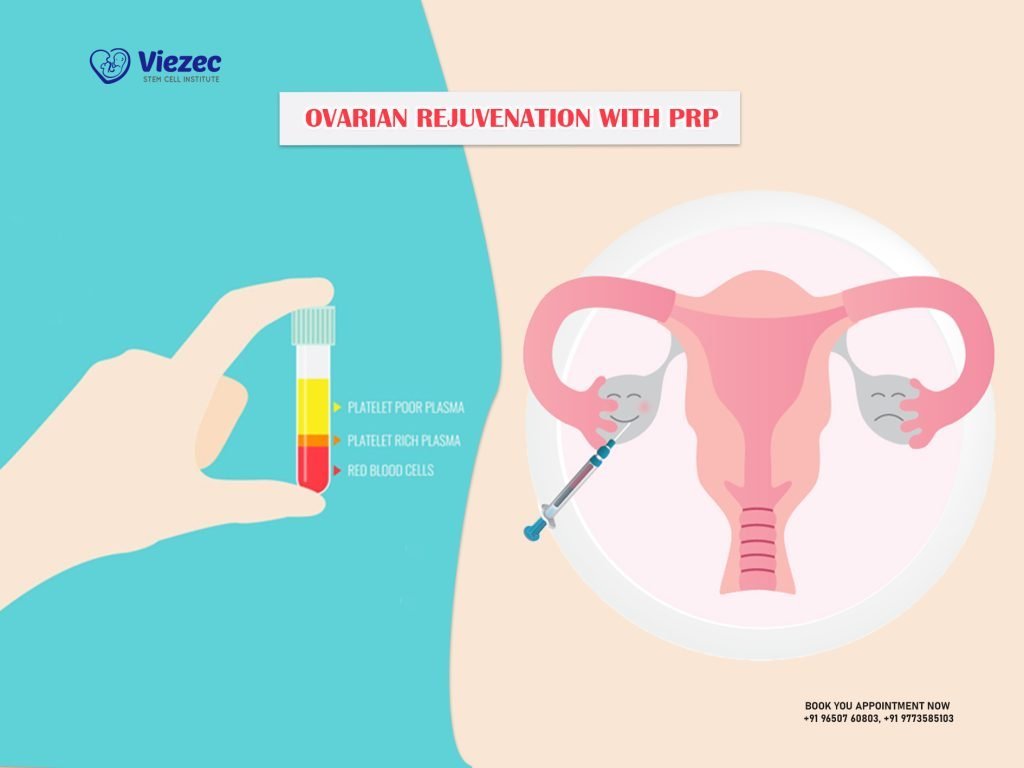 Ovarian Rejuvenation With PRP