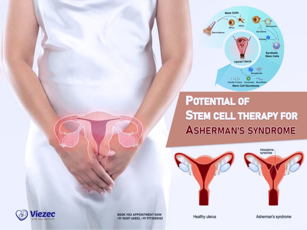 Potential of Stem Cell Therapy for Asherman's Syndrome