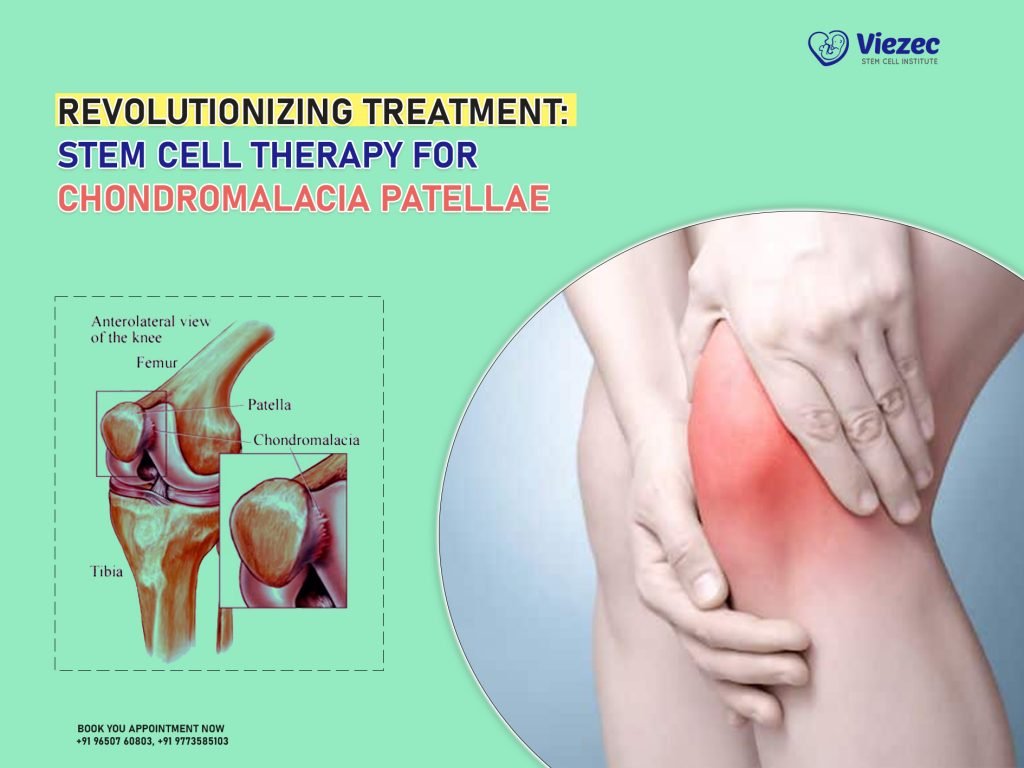 Revolutionizing Treatment: Stem Cell Therapy for Chondromalacia Patellae