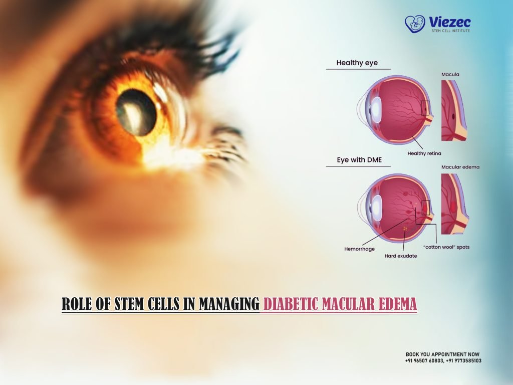 Role of Stem Cells in Managing Diabetic Macular Edema
