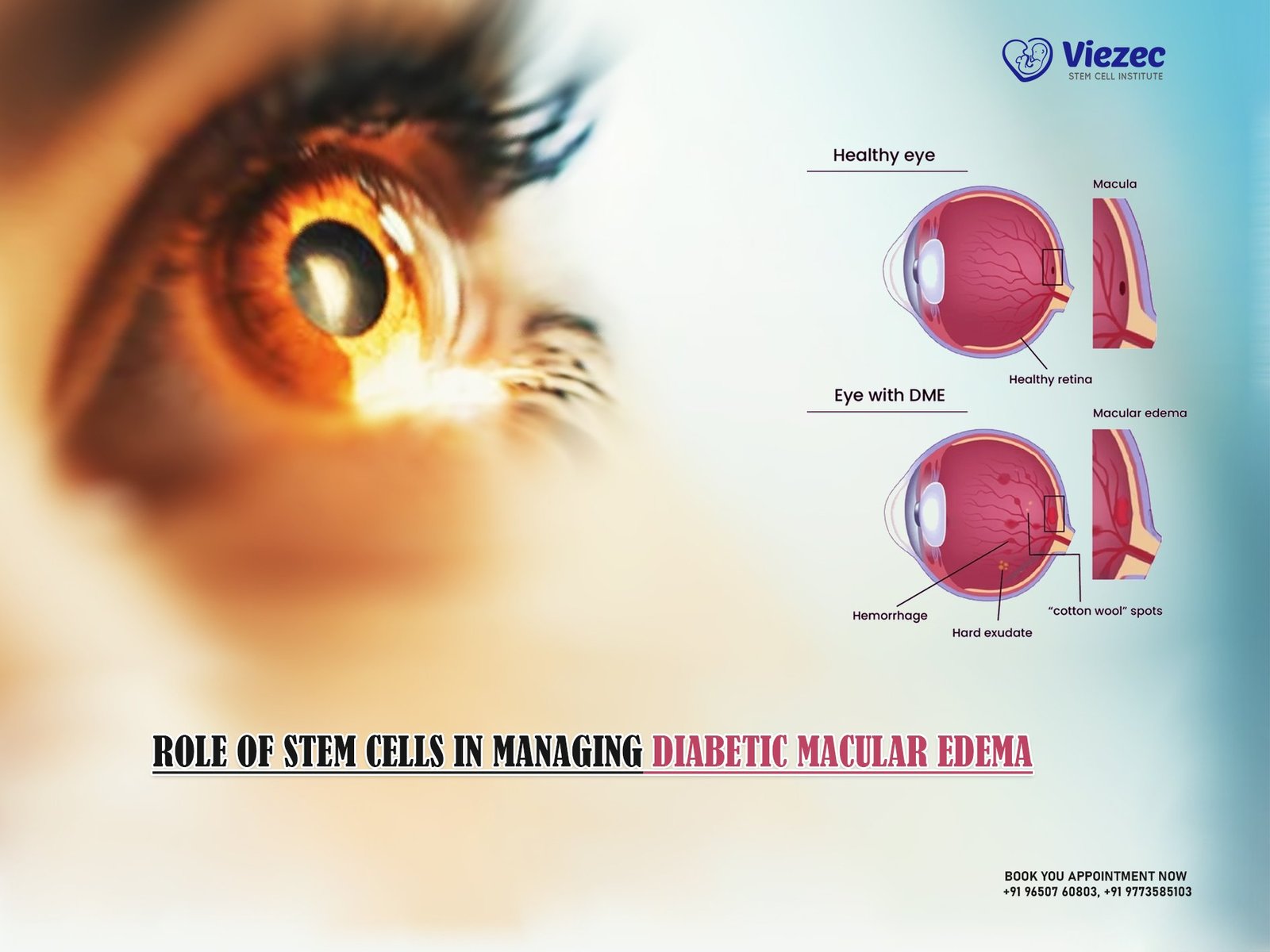 Role of Stem Cells in Managing Diabetic Macular Edema