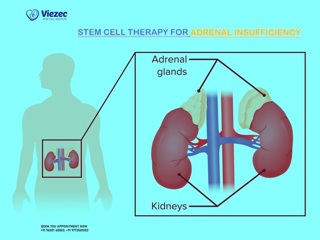 Stem Cell Therapy for Adrenal Insufficiency