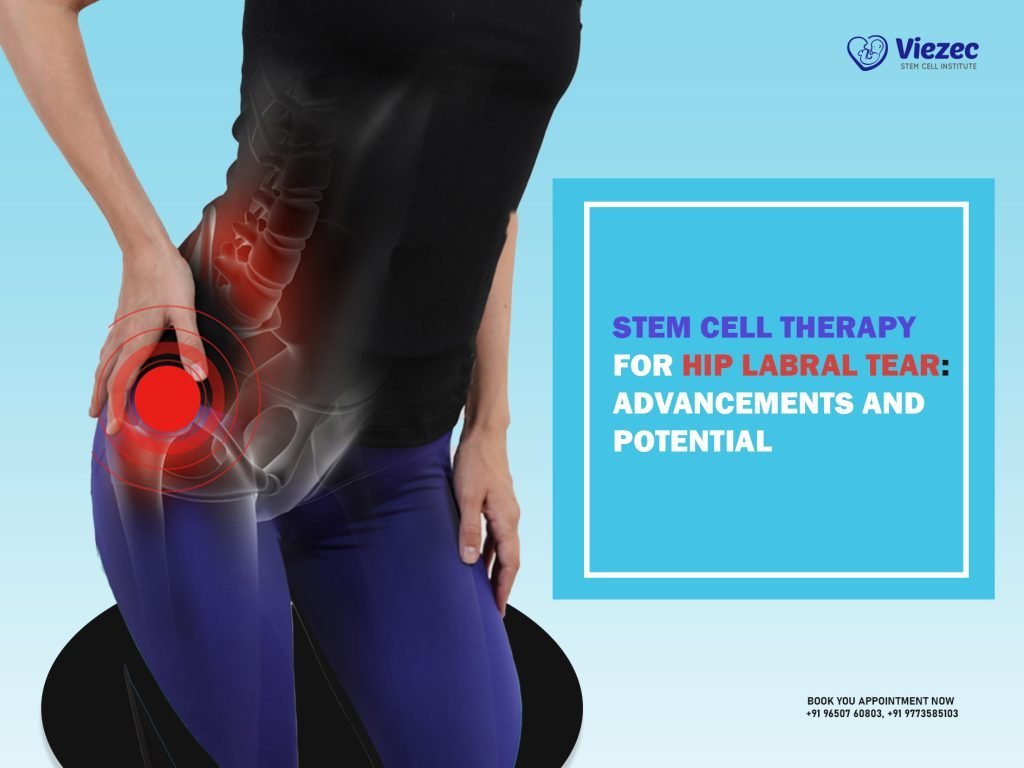Stem Cell Therapy for Hip Labral Tear: Advancements and Potential