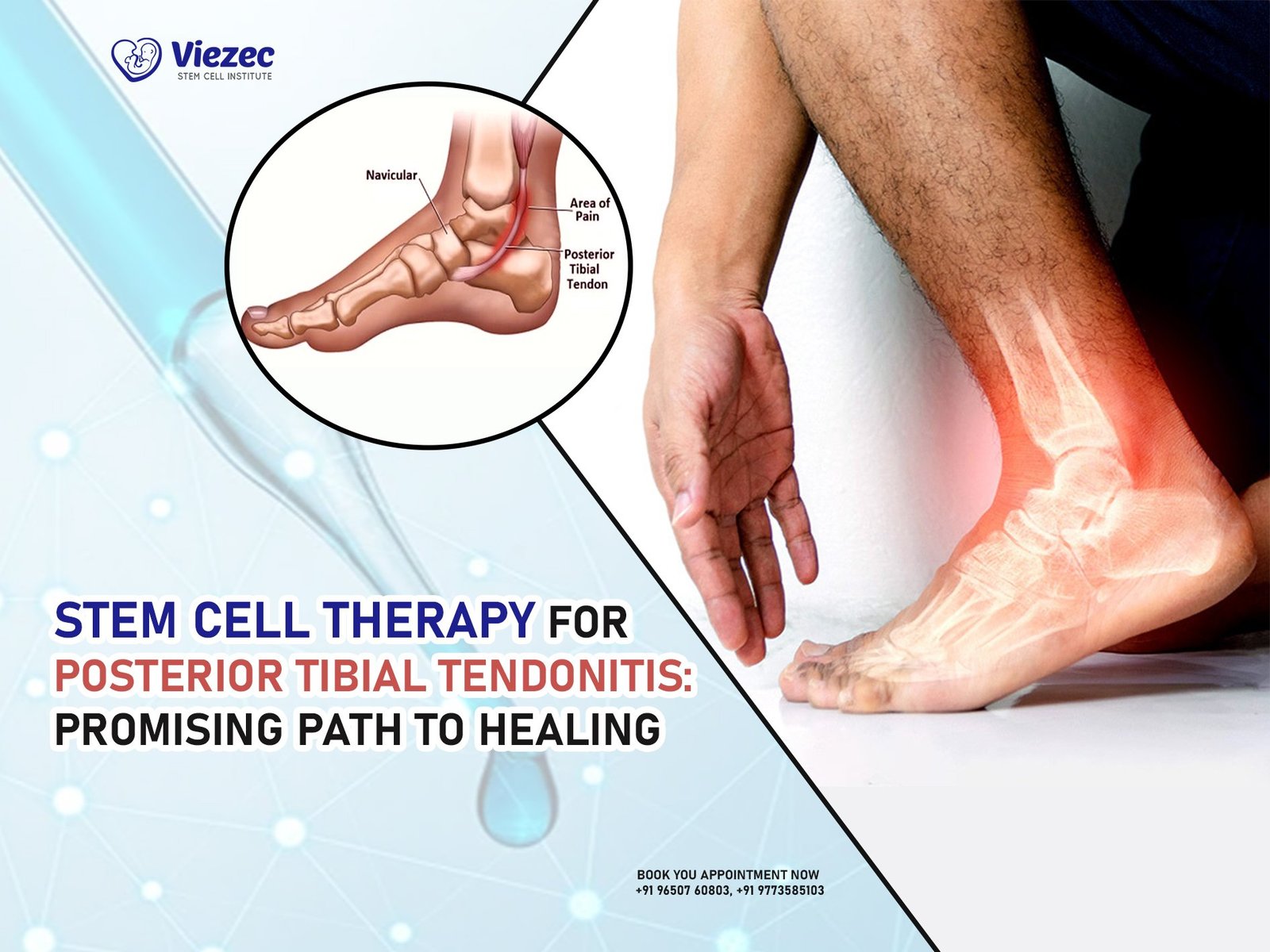 Stem Cell Therapy for Posterior Tibial Tendonitis in India