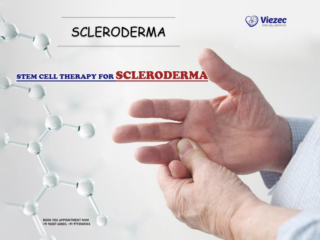 Stem Cell Therapy for Scleroderma