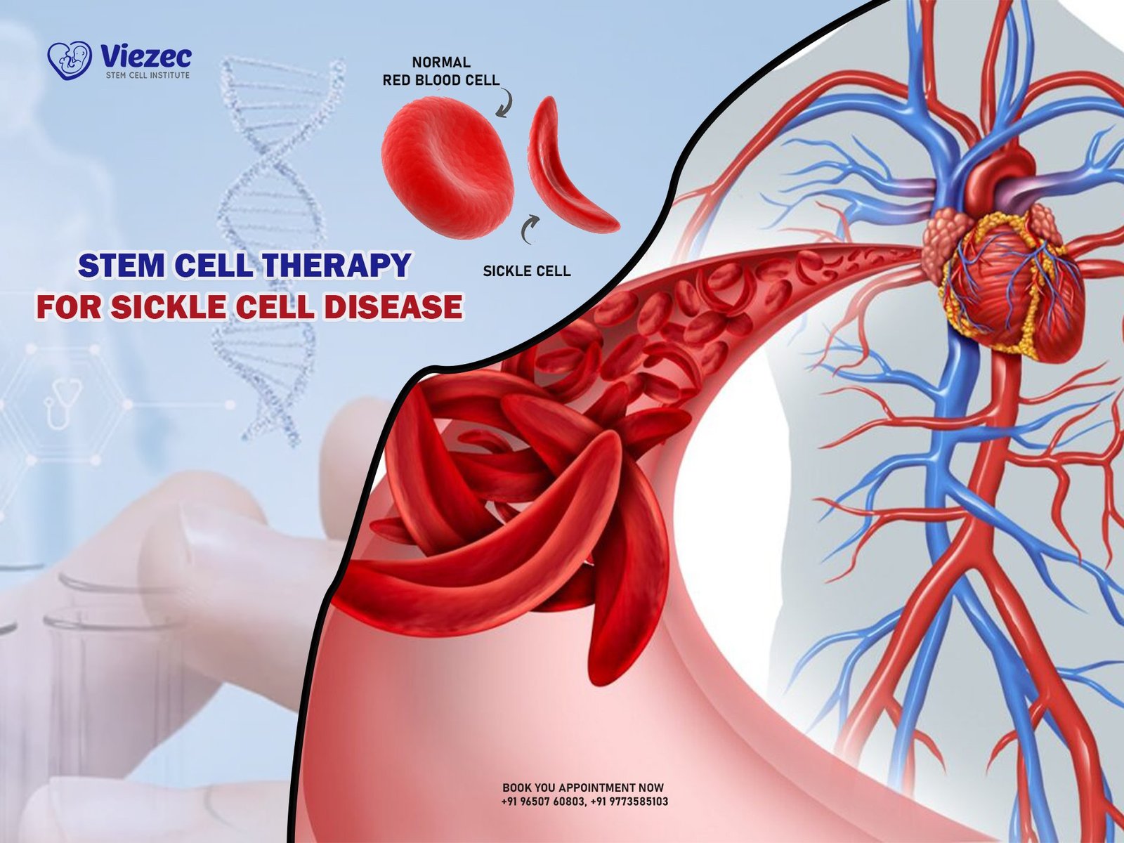 Stem Cell Therapy for Sickle Cell Disease