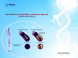 Treatment of Peripheral Arterial Disease Using Stem Cells