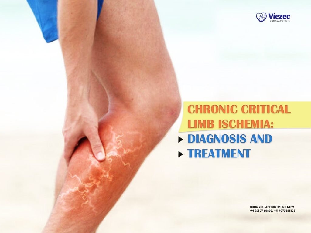 Chronic Critical Limb Ischemia: Diagnosis And Treatment