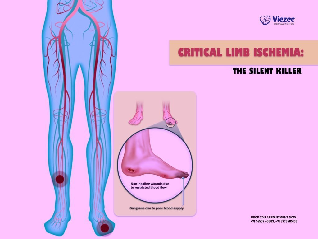 Critical Limb Ischemia: The Silent Killer