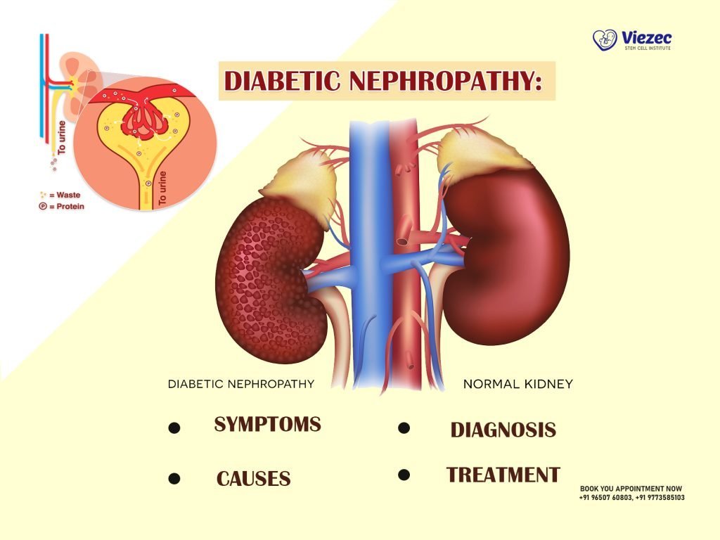Diabetic Nephropathy: Symptoms, Diagnosis, Causes, and Treatment