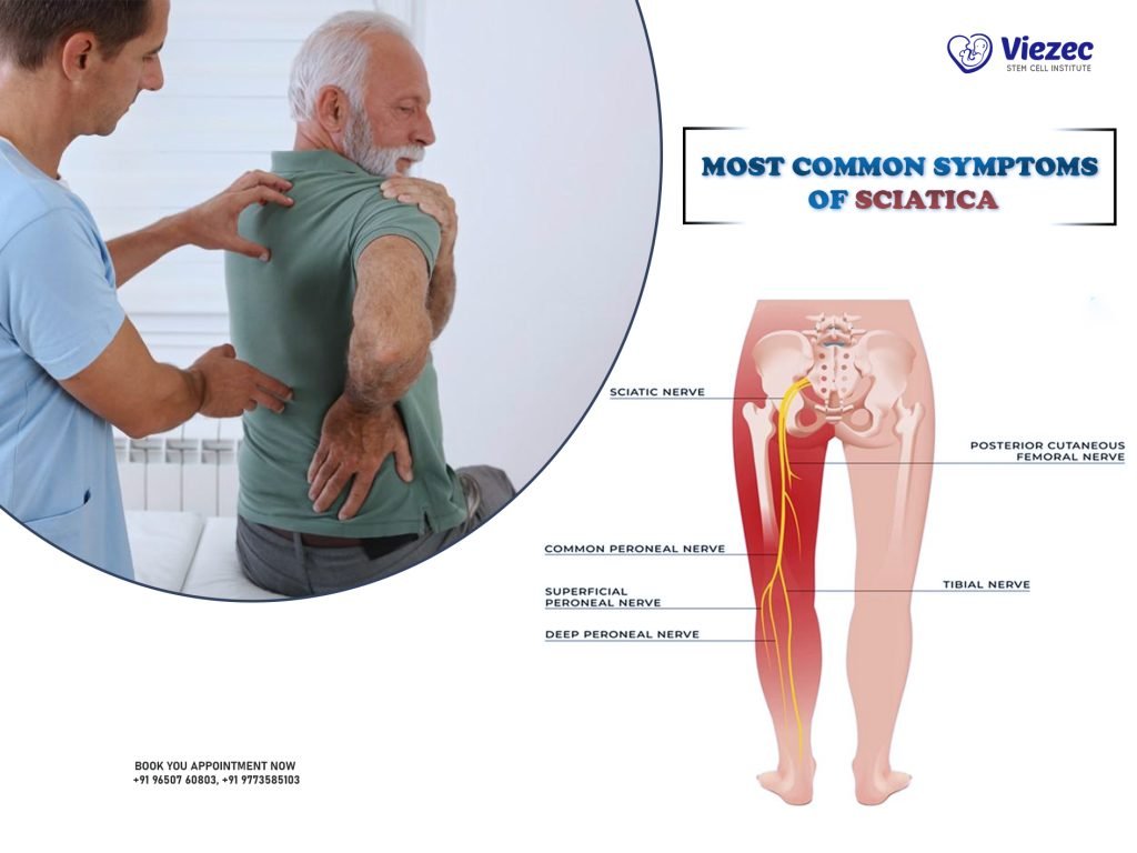 Most Common Symptoms of Sciatica