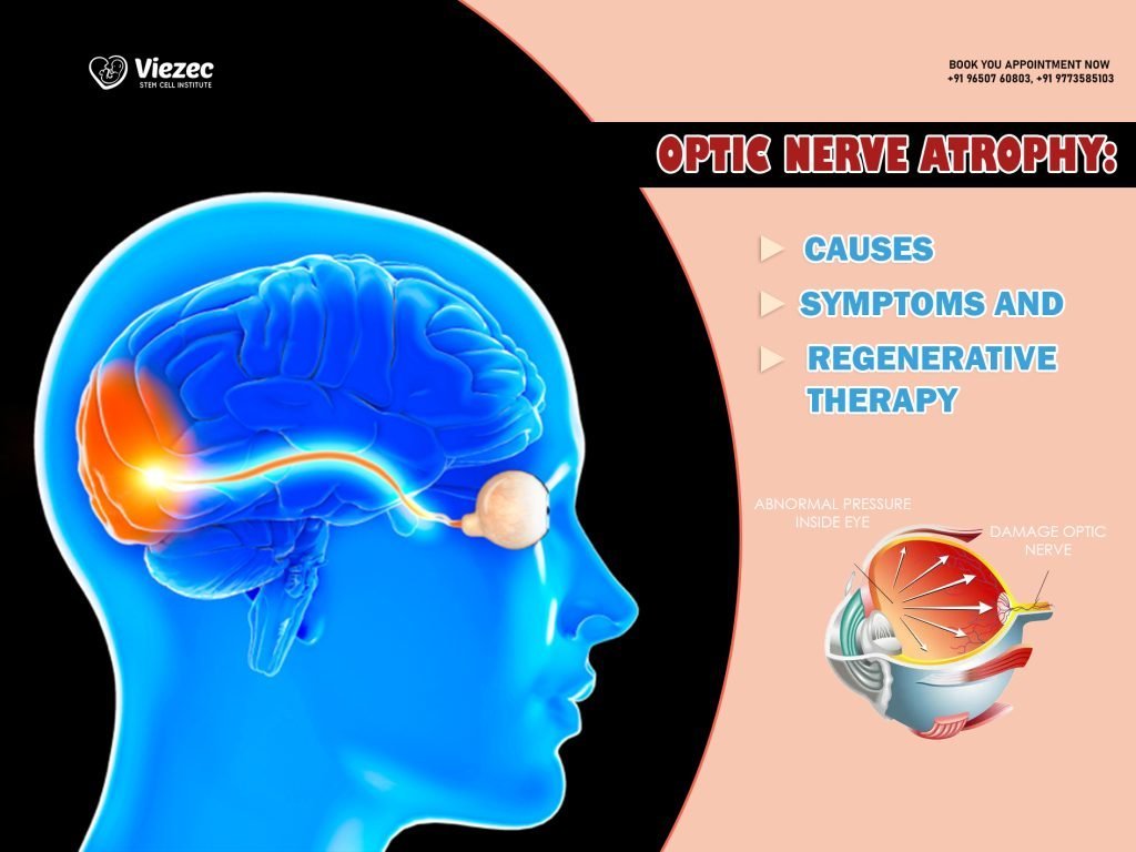 Optic Nerve Atrophy: Causes, Symptoms And Regenerative Therapy