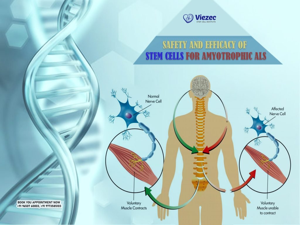 Safety and Efficacy of Stem Cells for Amyotrophic ALS