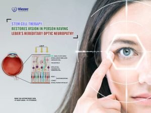 Stem Cell Therapy Restores Vision in Person having Leber’s Hereditary Optic Neuropathy