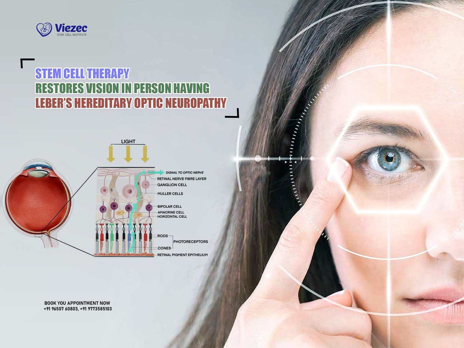Stem Cell Therapy Restores Vision in Person having Leber’s Hereditary Optic Neuropathy