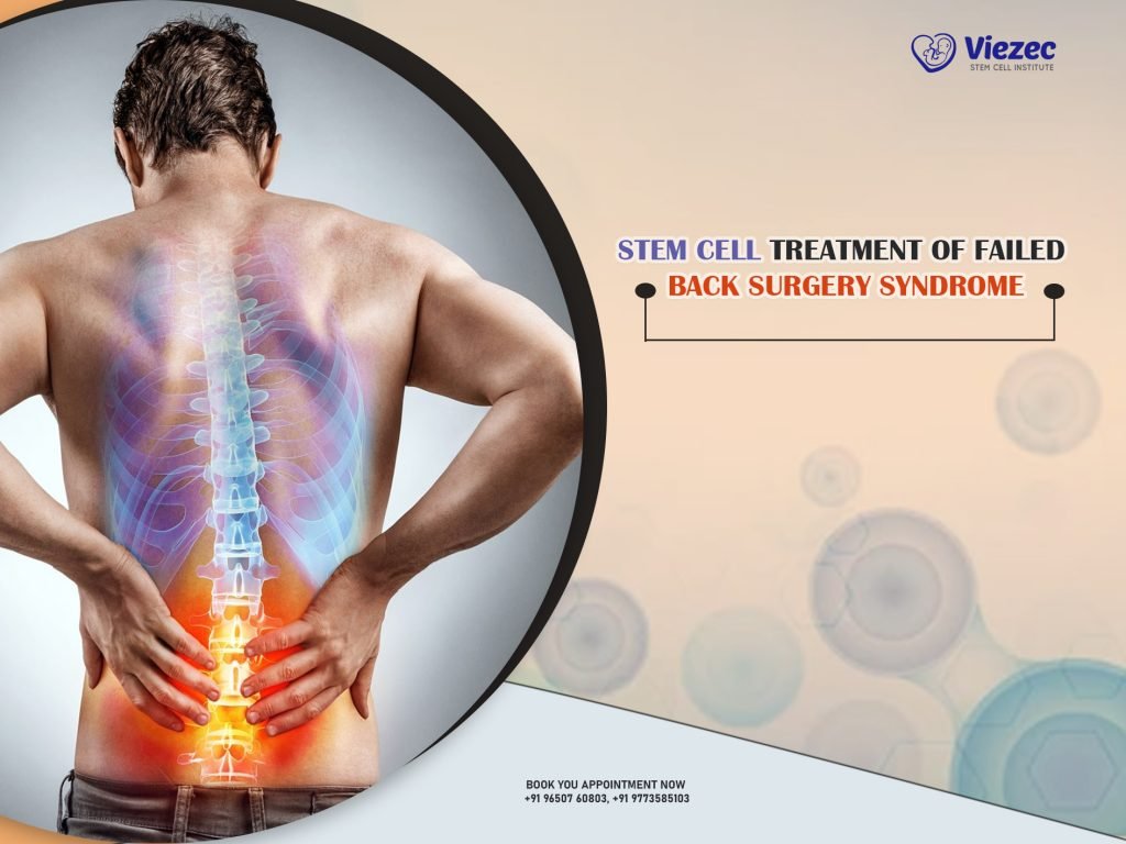 Stem Cell Treatment of Failed Back Surgery Syndrome