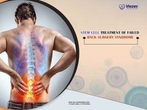 Stem Cell Treatment of Failed Back Surgery Syndrome