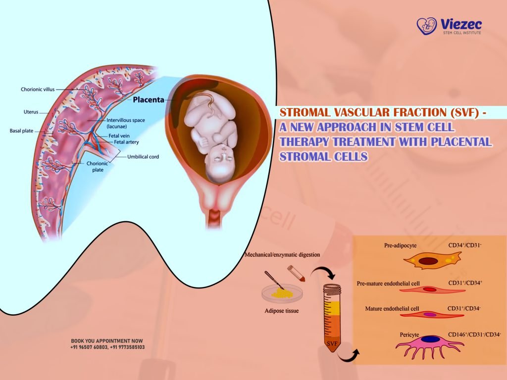 Stromal Vascular Fraction (SVF) - A New Approach in Stem Cell Therapy