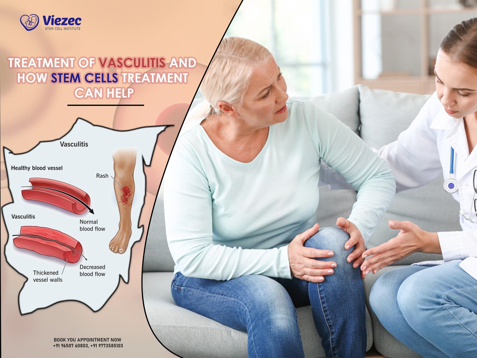 Treatment Of Vasculitis and How Stem Cells Treatment Can Help