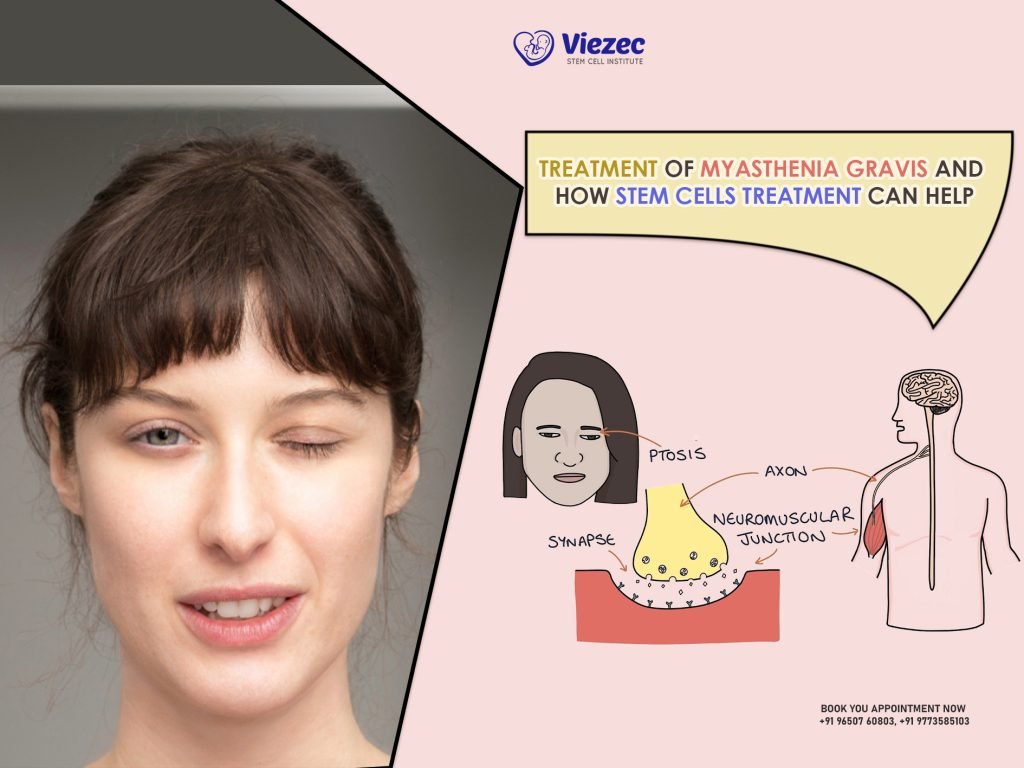 Treatment of Myasthenia Gravis and How Stem Cells Treatment Can Help