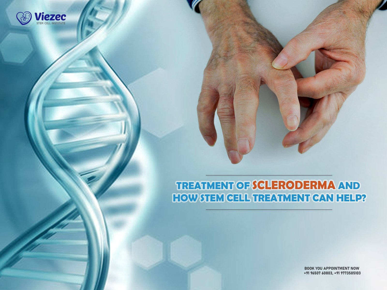 Treatment of Scleroderma and How Stem Cell Treatment Can Help