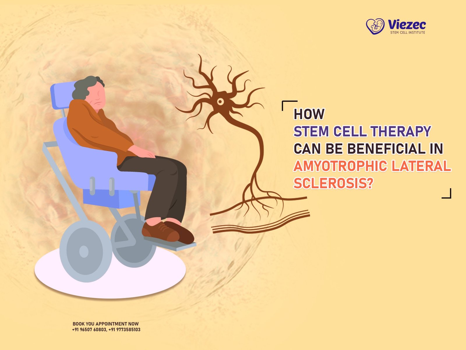 How Stem Cell Therapy Can Be Beneficial in Amyotrophic Lateral Sclerosis
