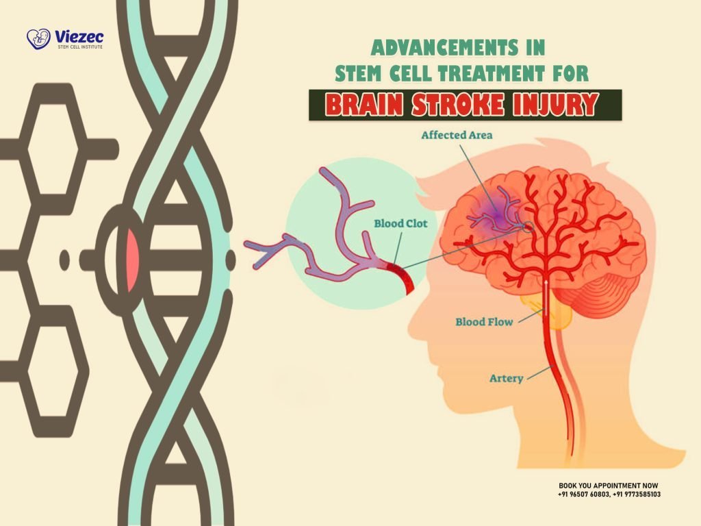 Advancements in Stem Cell Treatment for Brain Stroke Injury
