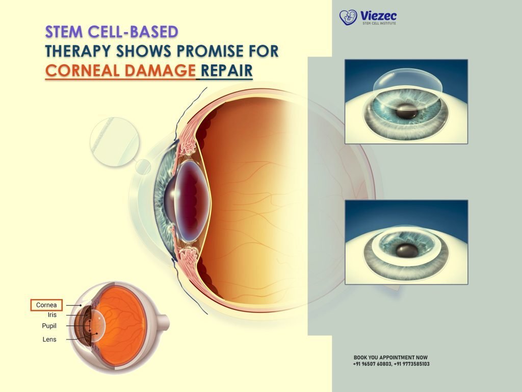 Stem Cell-Based Therapy Shows Promise for Corneal Damage Repair