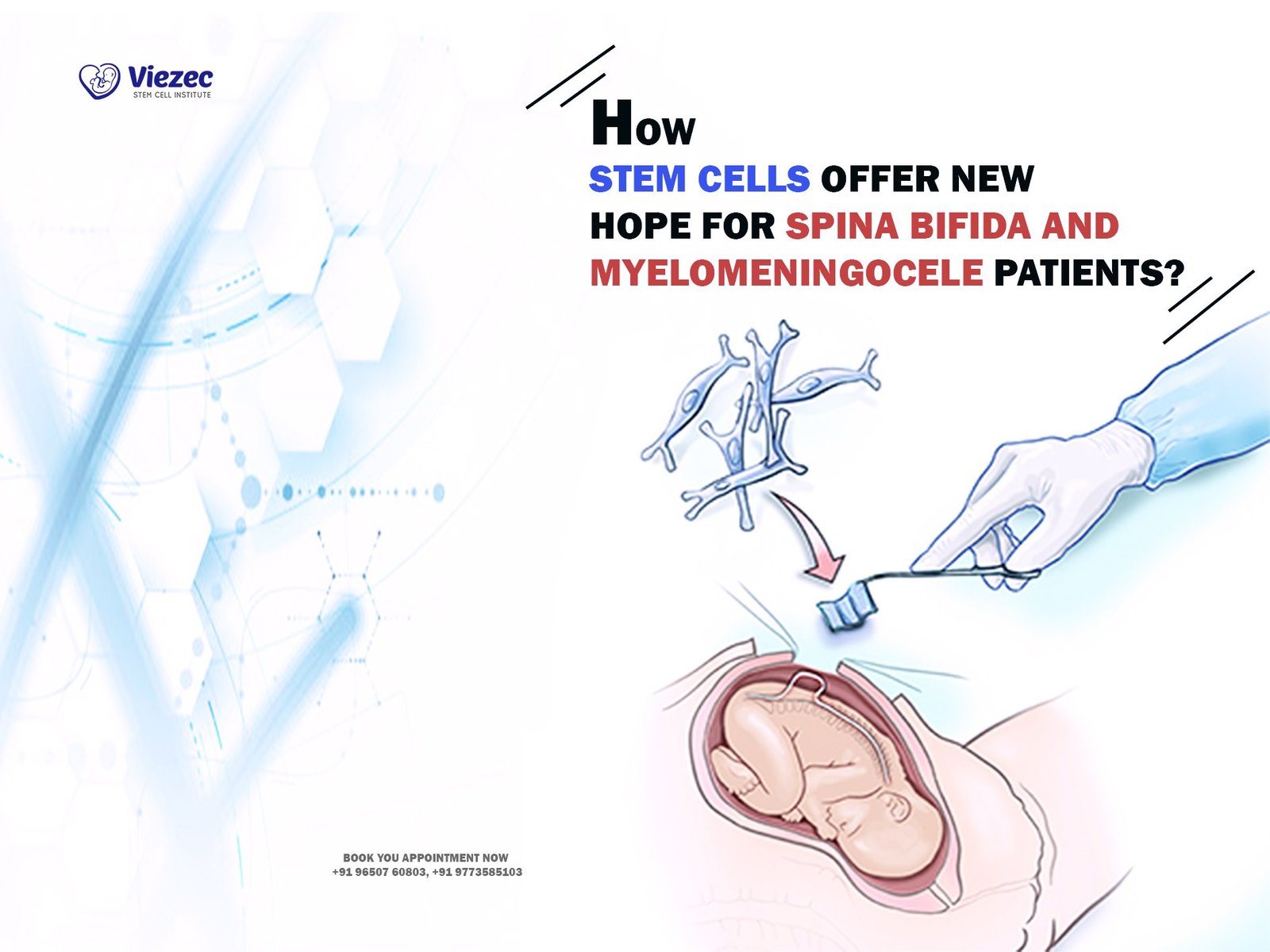 How Stem Cells Offer New Hope for Spina Bifida and Myelomeningocele Patients