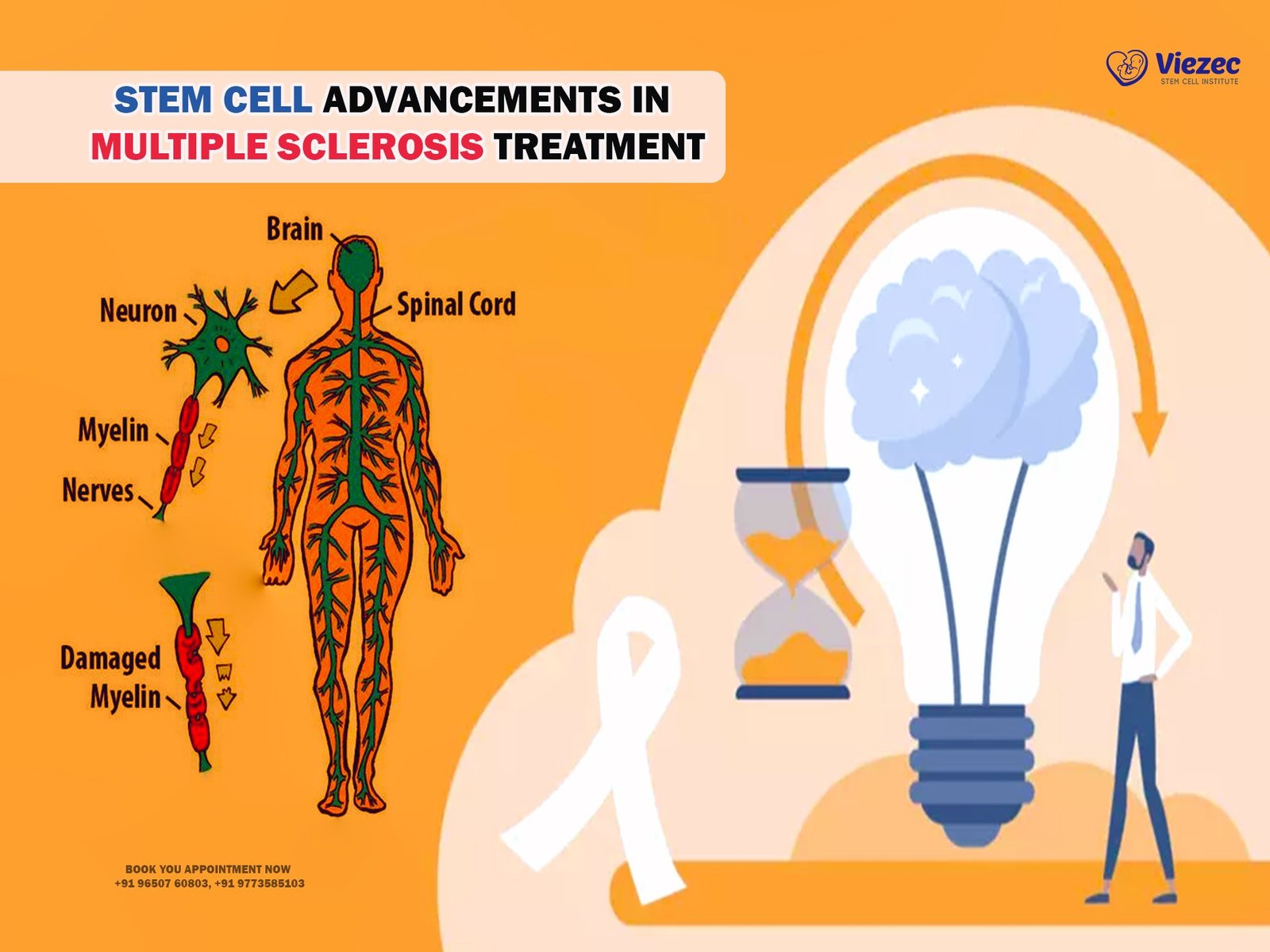Stem Cell Advancements in Multiple Sclerosis Treatment