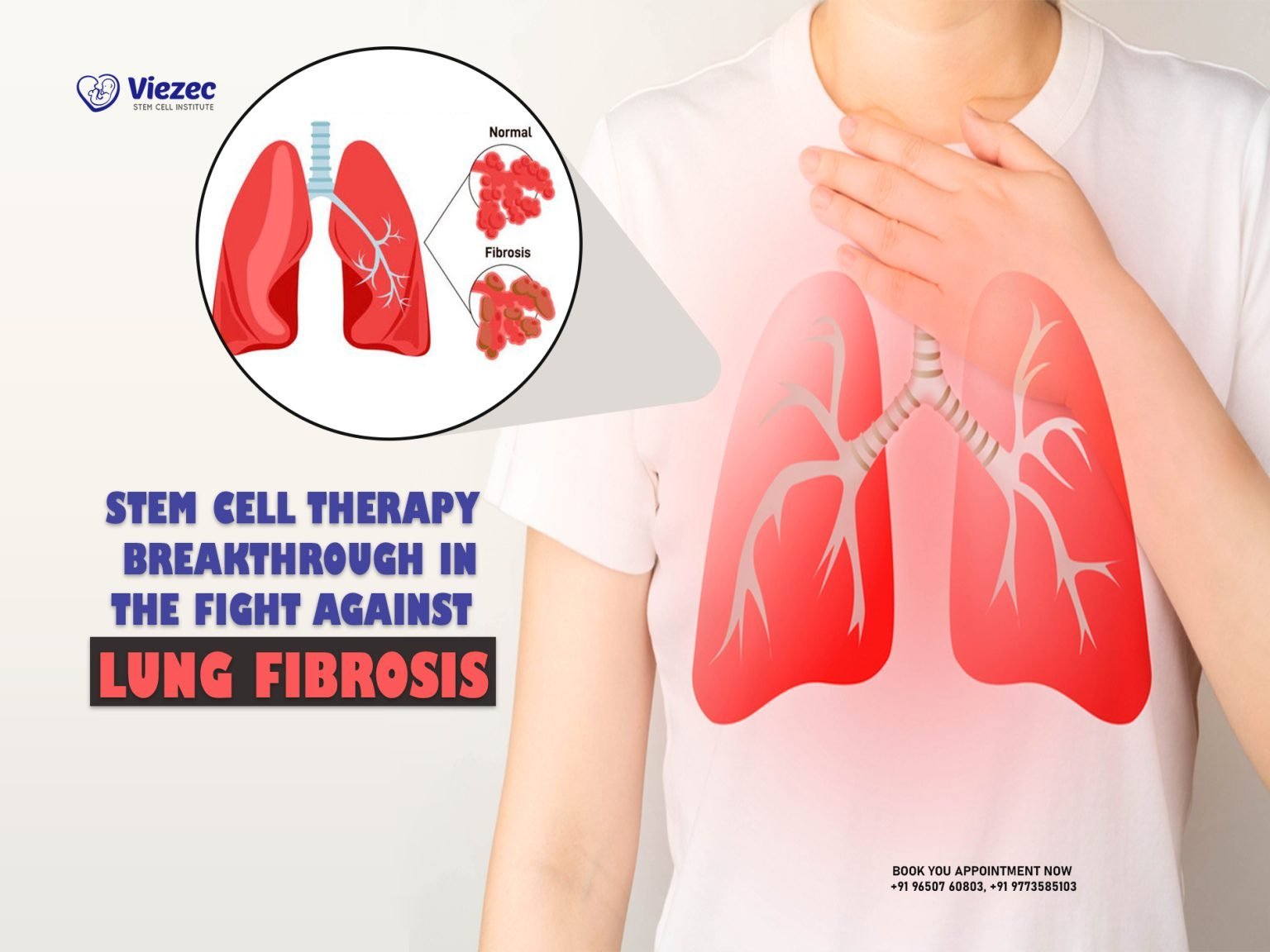 Stem Cell Therapy Breakthrough Fight against Lung Fibrosis