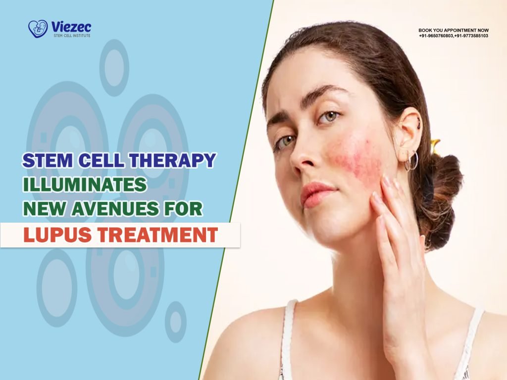 Stem Cell Therapy Illuminates New Avenues for Lupus Treatment