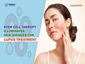 Stem Cell Therapy Illuminates New Avenues for Lupus Treatment