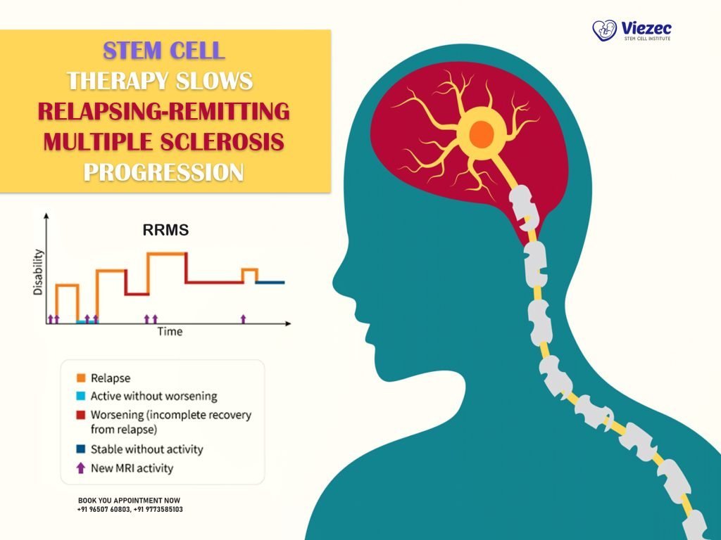 Stem Cell Therapy Slows Relapsing-remitting Multiple Sclerosis Progression