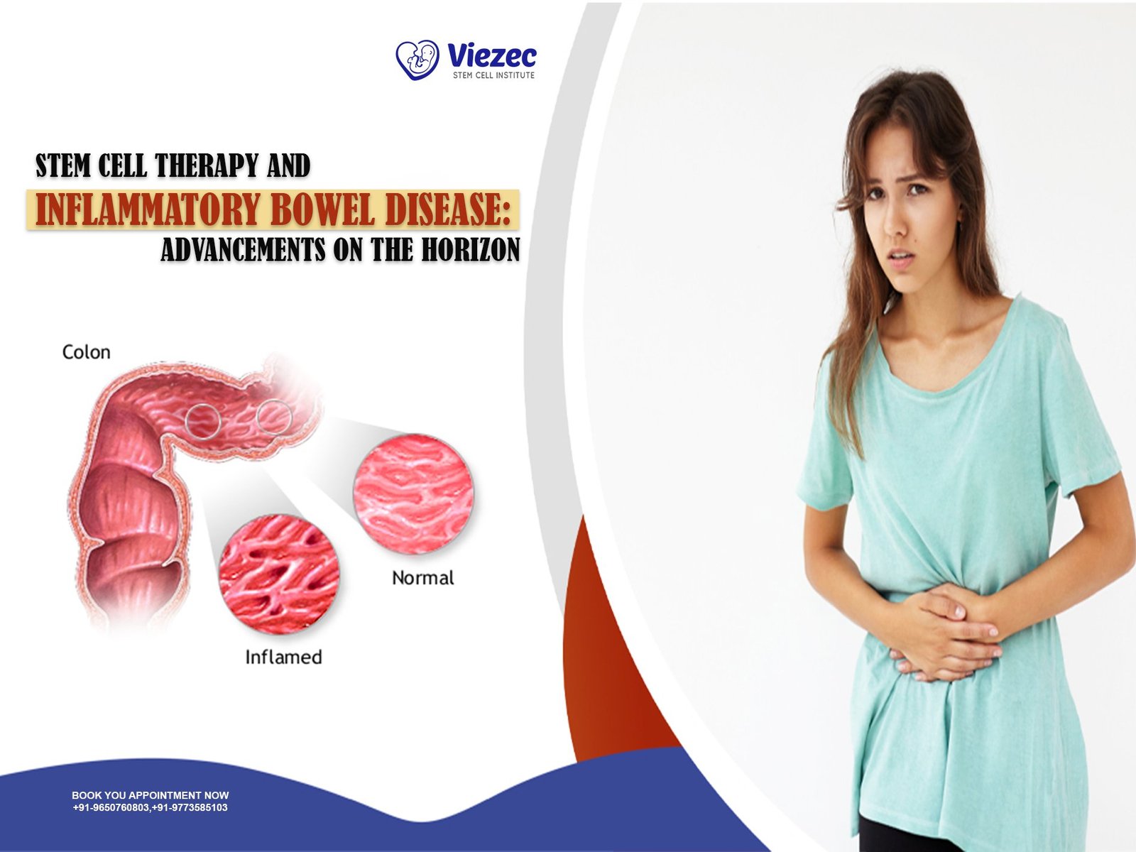 Stem Cell Therapy and Inflammatory Bowel Disease: Advancements on the Horizon