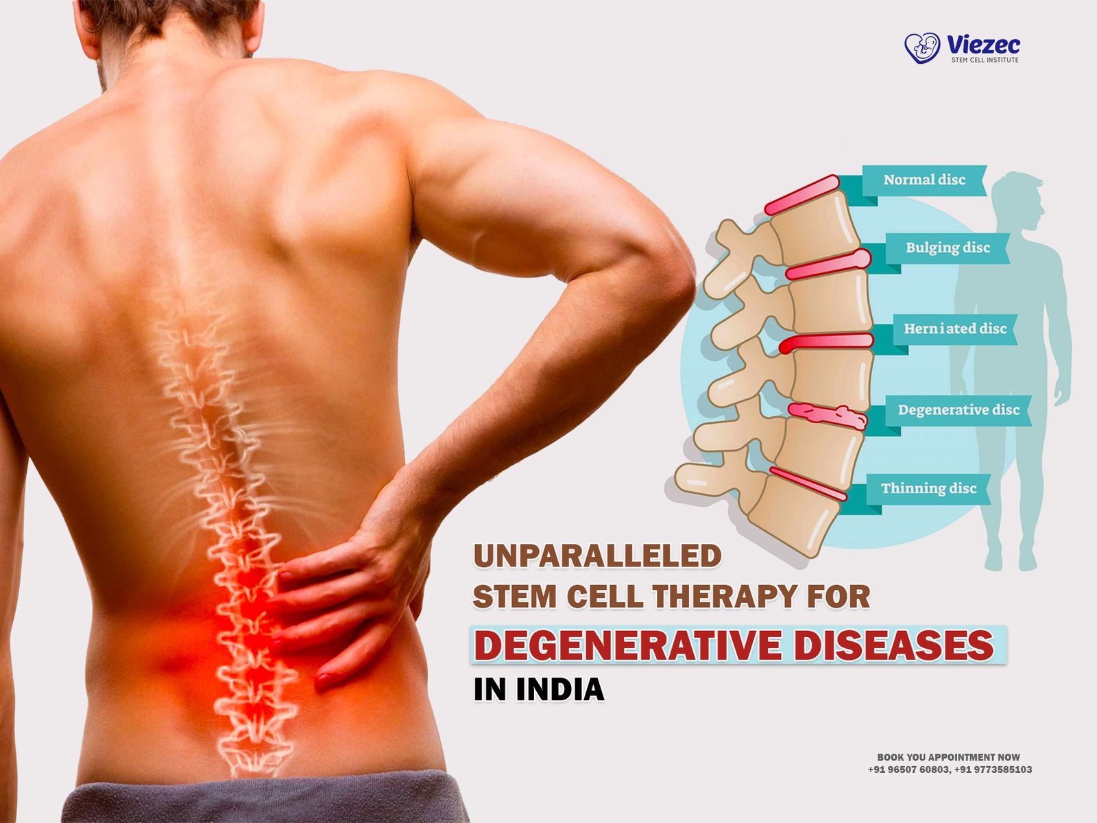 Unparalleled Stem Cell Therapy for Degenerative Diseases in India