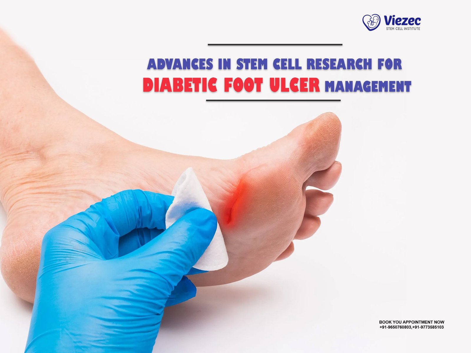 Advances in Stem Cell Research for Diabetic Foot Ulcer Management