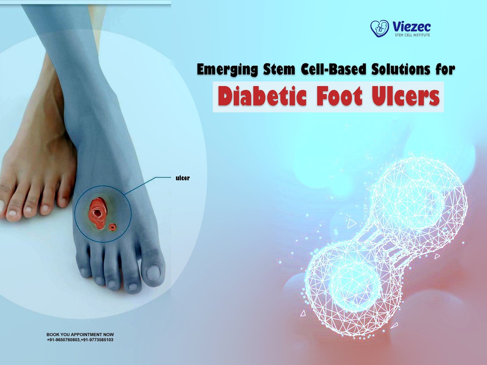 Emerging Stem Cell-Based Solutions for Diabetic Foot Ulcers