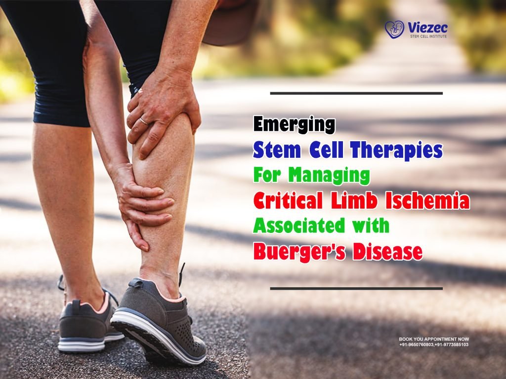 Emerging Stem Cell Therapies for Managing Critical Limb Ischemia Associated with Buerger's Disease