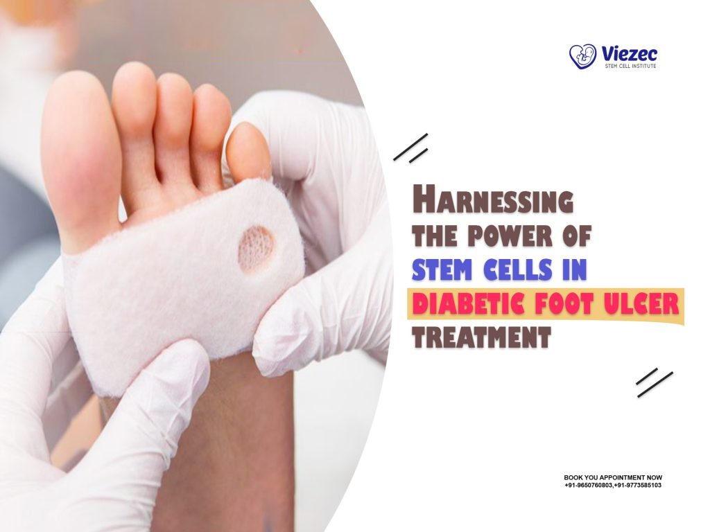 Harnessing the Power of Stem Cells in Diabetic Foot Ulcer Treatment