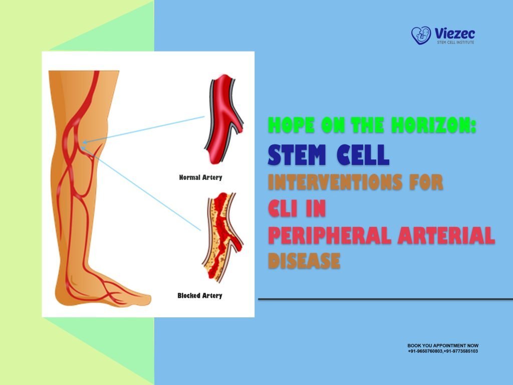 Hope on the Horizon: Stem Cell Interventions for CLI in Peripheral Arterial Disease